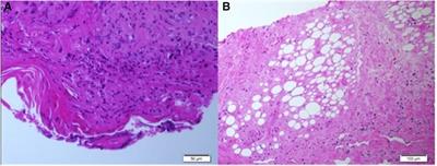 Acrofacial necrotic ulcers in an infant: An undiagnosed presentation